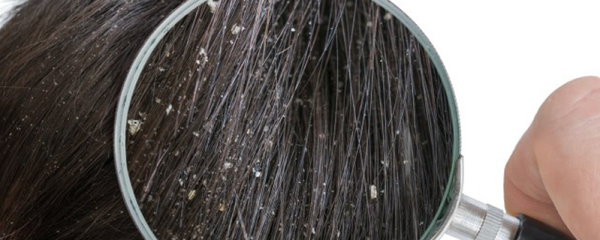 头皮屑突然增多的原因，为什么头皮屑突然增多