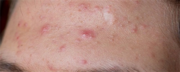 脸上长粉刺该如何解决，脸上长粉刺怎么办