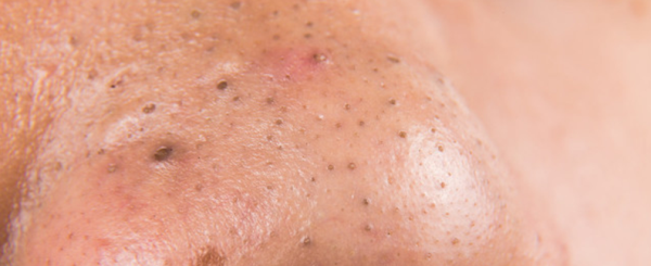 长黑头是怎么回事，黑头是怎么形成的