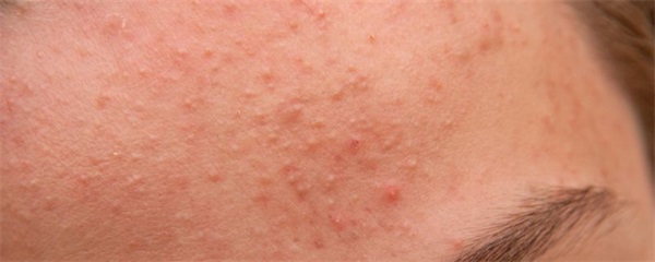 有效的祛粉刺小方法，分享几个祛除粉刺的方法