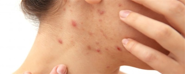 为什么会出现粉刺，粉刺形成有这些原因