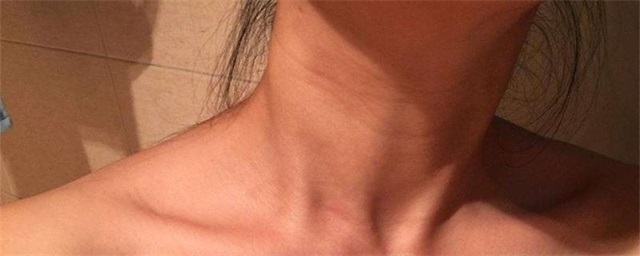 什么年龄开始有颈纹