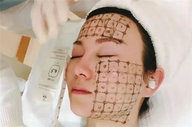 热玛吉对怀孕有影响吗，热玛吉对法令纹效果怎么样