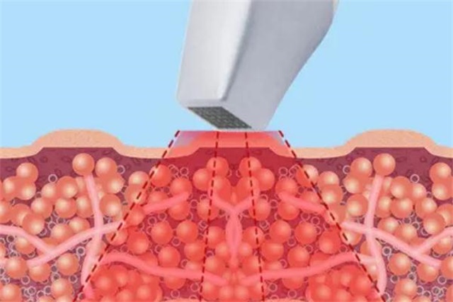 热玛吉要恢复多久，热玛吉要避开月经期的原因