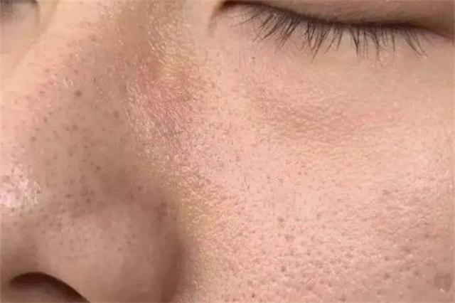 毛孔粗大会持续一辈子吗，毛孔粗大会自己慢慢变小吗