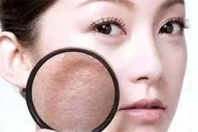 毛孔粗大有几种类型，毛孔粗大有痘坑怎么修复