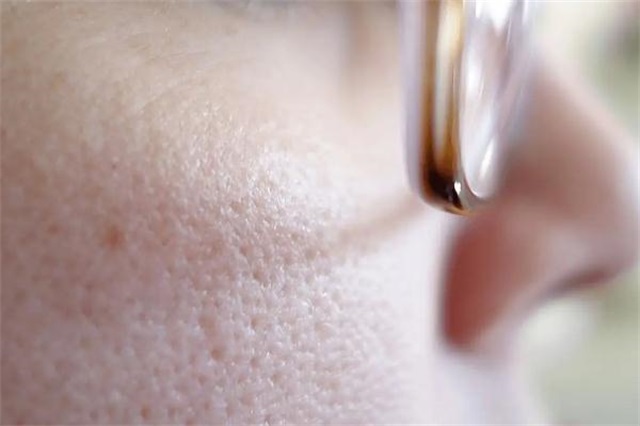 毛孔粗大要不要用洗面奶，毛孔粗大要补水还是控油