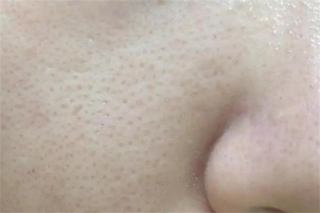 毛孔粗大是什么意思，毛孔粗大是缺乏什么维生素