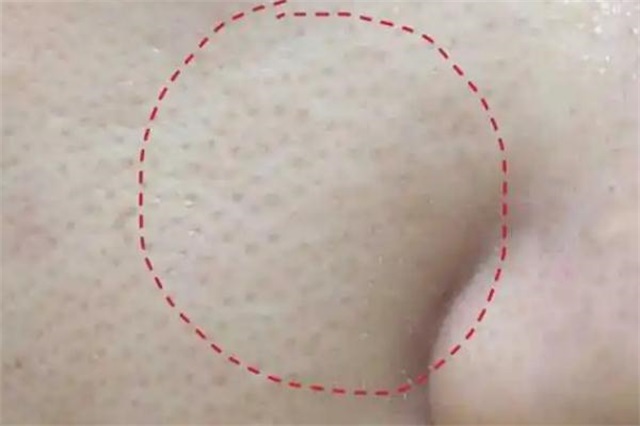 毛孔粗大是缺水吗，毛孔粗大是永久的吗