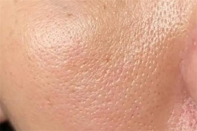 毛孔粗大能修复吗，毛孔粗大有黑头怎么办