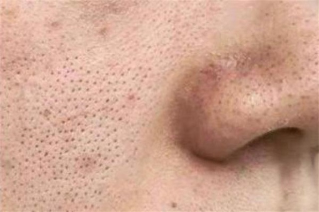 毛孔粗大用什么护肤品可以改善，毛孔粗大怎么办怎么收缩毛孔