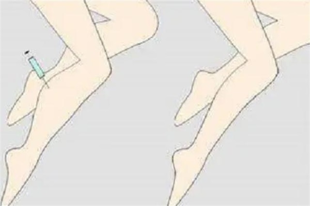 瘦腿针可以自己打吗，瘦腿针可以瘦几厘米