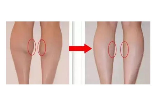瘦腿针能维持多长时间，瘦腿针会导致静脉曲张吗