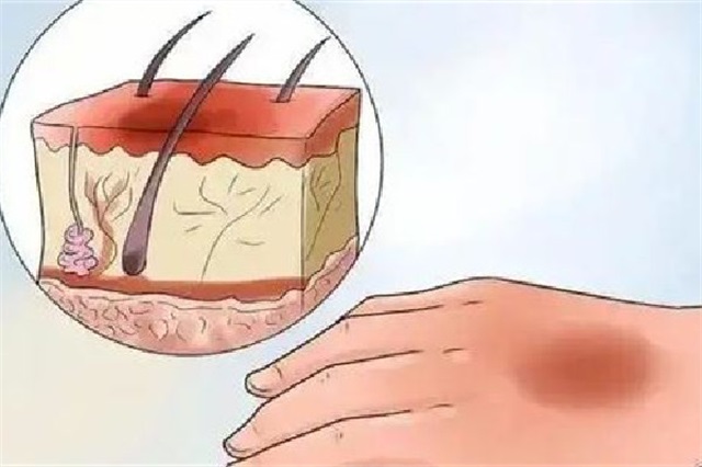 祛疤手术后不能吃什么，祛疤手术后要戒辛辣多长时间