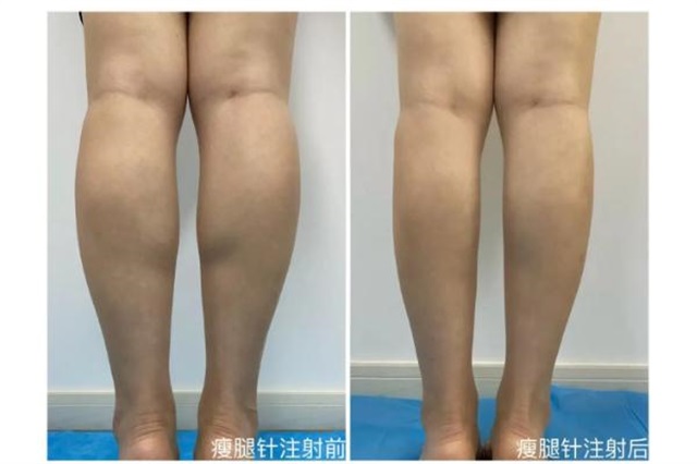 瘦腿针有没有副作用，瘦腿针真的能瘦腿吗