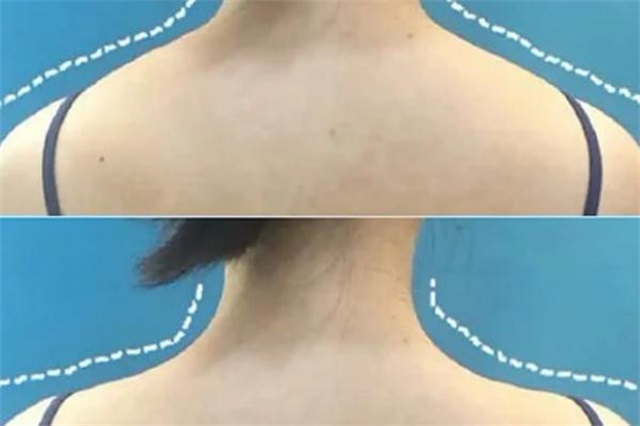 瘦肩针打几次才能永久，瘦肩针打一针能保持多久