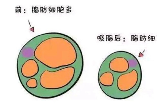 吸脂去三甲医院还是美容医院，吸脂可以报医保吗