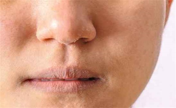 皮肤干燥缺什么维生素，冬季皮肤干燥是怎么回事