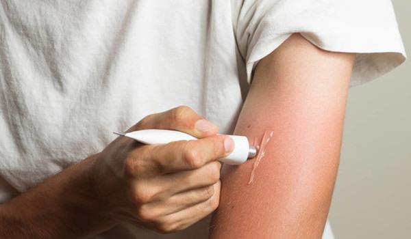 晒伤后很痒怎么办，晒伤护理方法