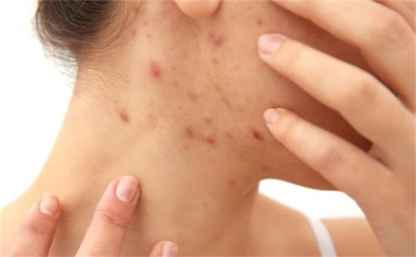 皮炎人群的日常护理法则，皮炎轻松解决方法