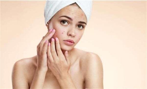 为什么长痘痘，脸上痘痘可不可以挤