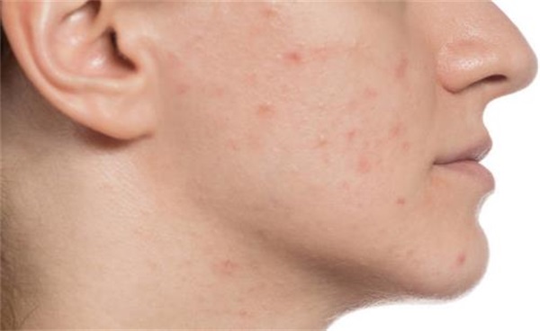 长闭合性粉刺的原因，闭合性粉刺很烦恼