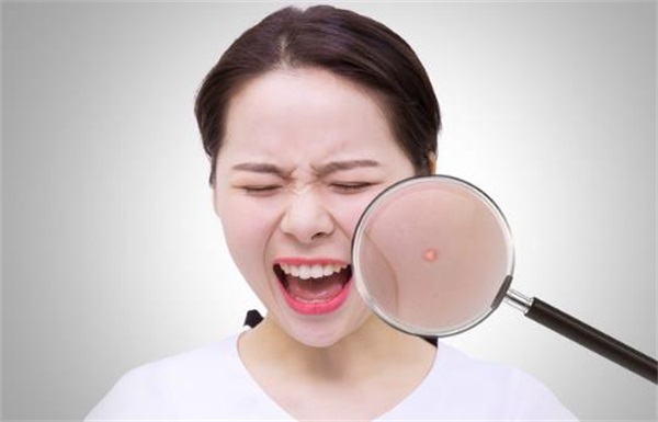 脸上长痘痘究竟是什么原因导致的