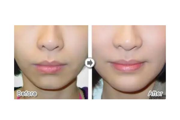 玻尿酸填充下巴是怎么形成的，玻尿酸填充下巴是不是越尖越好