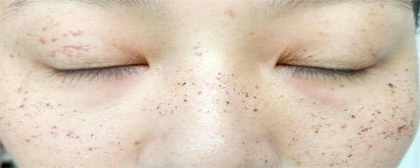 长雀斑应该注意什么