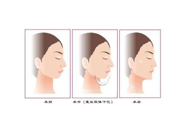 垫下巴手术风险大吗，垫下巴什么方式最安全永久