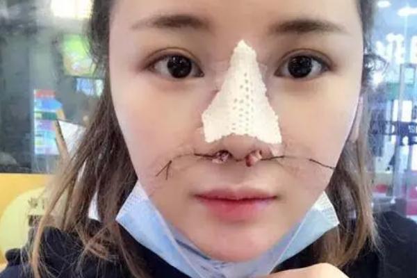 膨体隆鼻感染几率，膨体隆鼻感染有什么症状