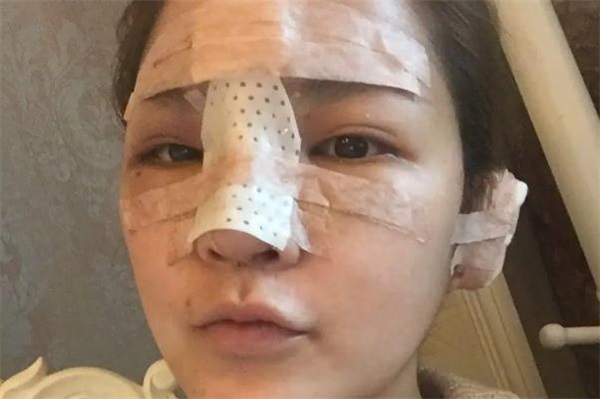耳软骨隆鼻有点歪可以调整吗，耳软骨隆鼻有什么后遗症