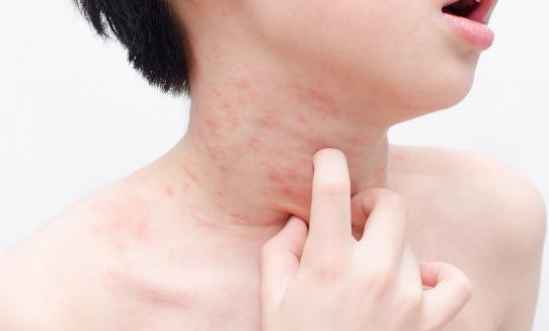 为什么现代的人越来越容易过敏，生活中最常见的三种敏感肌