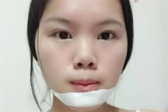 垫下巴要换身份证吗，垫下巴要住院吗