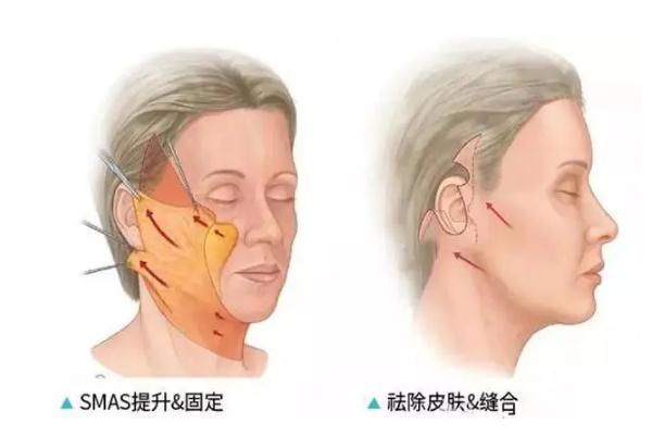 拉皮手术多久恢复自然，拉皮手术能维持几年