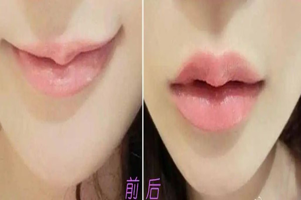 丰唇用什么破尿酸比较好，丰唇要用小分子还是大分子