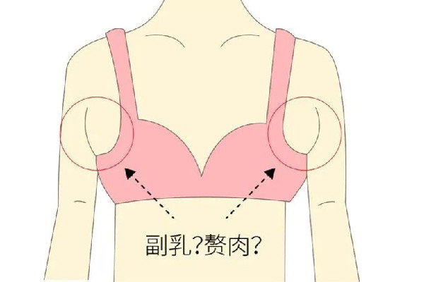 副乳切除手术怎么才能看不到疤痕，副乳切除手术会有疤痕吗