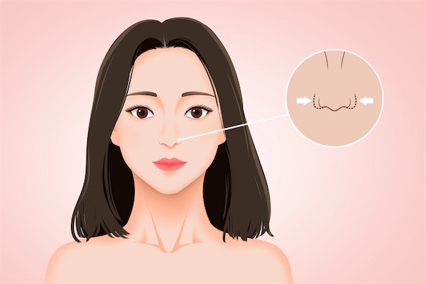 面膜敷完鼻翼浮出白头该怎么处理