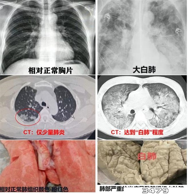 白肺怎么检查，怎么判断白肺 白肺前兆，白肺的ct表现